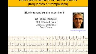 4h Aberration ventriculaire bloc de branche ou ESV  ECG Dr Taboulet [upl. by Eytak]