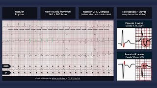 Atrioventricular Nodal Reentry Tachycardia AVNRT ECG [upl. by Yornoc939]