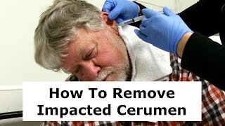 Removing Impacted Cerumen from a Patients Ear [upl. by Prior]