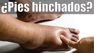 PIES HINCHADOS o RETENCIÓN de LÍQUIDOS 🦶 CAUSAS PREVENCIÓN y TRATAMIENTO 👣 DR IVÁN GUTIÉRREZ ROMERO [upl. by Meehyr]