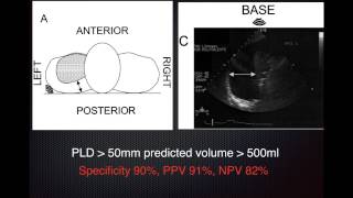 Estimate Pleural Effusion Volume [upl. by Elleynad739]