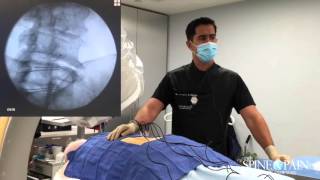 Radiofrequency Ablation Procedure [upl. by Htaeh]