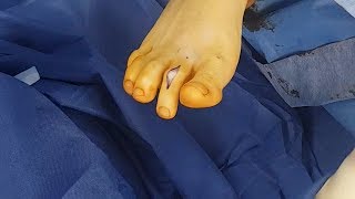 Surgical Correction of Hammertoe deformity [upl. by Francois]