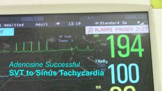 SVT or Supraventricular Tachycardia [upl. by Priscella]