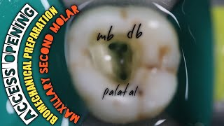 Access Opening in Maxillary Second Molar Biomechanical Preparation  Protaper Rotary Endodontics [upl. by Cogswell950]