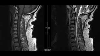 Noncontrast MRI cervical spine search pattern [upl. by Marozik]