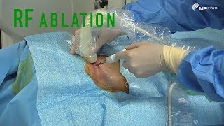 Radiofrequency Ablation [upl. by Celesta]