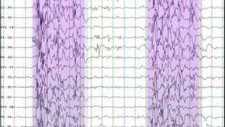 EEG Reading Rounds Burst Suppression [upl. by Quill425]