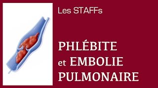 Phlébite et Embolie pulmonaire  12  STAFFs Saint Camille [upl. by Ykciv]