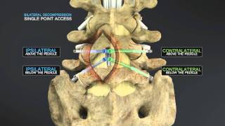 Medical Animation of Lumbar Stenosis Decompression [upl. by Cutcheon]