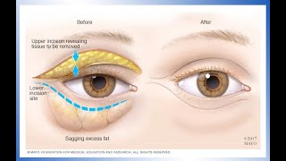 Dallas Upper Eyelid Blepharoplasty Recovery with Dr Sam Lam [upl. by Xuaeb388]