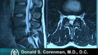 How to Read a MRI of a Lumbar Herniated Disc  Lower Back Pain  Colorado Spine Surgeon [upl. by Imit]