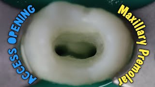 access opening of maxillary first premolar  step by step demonstration [upl. by Daughtry]