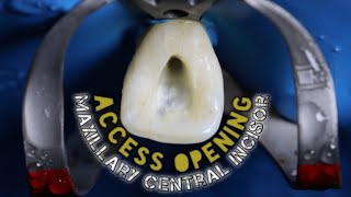 Access Opening of Maxillary Central Incisor  step by step demonstration [upl. by Erapsag]