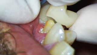 Dental Crown EXPLAINED and how much Tooth Youll Lose [upl. by Oenire]