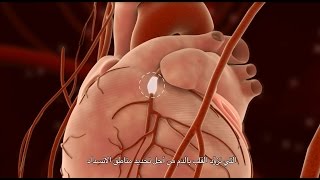 Percutaneous Coronary Intervention PCI [upl. by Felicdad]