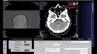 CT scan of brainOrbit with contrast techniq [upl. by Fitzgerald]