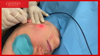 Dr Tapan performs Endolift®  INSTAGRAM LIVE 21052021 Eufoton® [upl. by Kenyon]