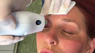 Thermage Alternative to Eyelid Surgery [upl. by Aeslehc]