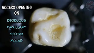 Access Opening Demonstration On Deciduous Maxillary Second Molar [upl. by Mandy]