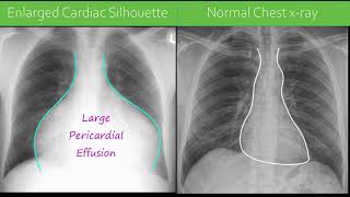 Chest xray  Pericardial Effusion [upl. by Richart]