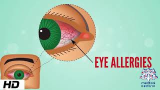 How To Get Rid Of Dry Eyes  4 Advanced Home Treatments [upl. by Haines]