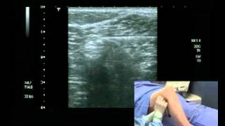 Popliteal Block Ultrasound guided  lateral approach [upl. by Ragg38]