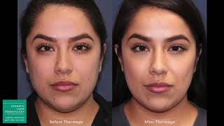 Thermage Skin Tightening Treatment by Leysin Fletcher PAC  Cosmetic Laser Dermatology San Diego [upl. by Dat]