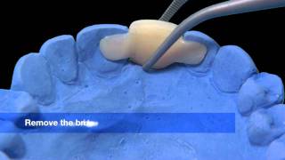 Revascularization  Regenerative Endodontic Procedure [upl. by Dorella]