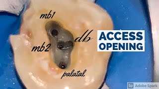 Maxillary Molar Access Opening MB2 [upl. by Namyaw636]