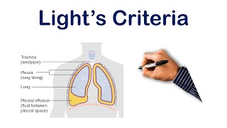 Pleural Effusion Lights Criteria  USMLE STEP COMLEX NCLEX [upl. by Mersey]