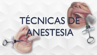 TECNICAS DE ANESTESIA LOCAL ODONTOLOGIA REPASO [upl. by Peg]