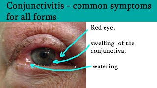 Red or pink eye  Conjunctivitis symptoms and treatment [upl. by Hildagarde]