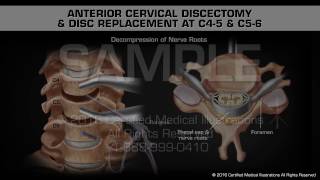 Anterior Cervical Discectomy amp Disc Replacement at C45 amp C56 [upl. by Ellerahc]