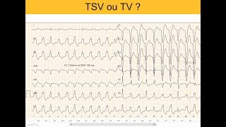 Tachycardie 130min et QRS larges Quiz ECG Dr Taboulet [upl. by Einniw779]