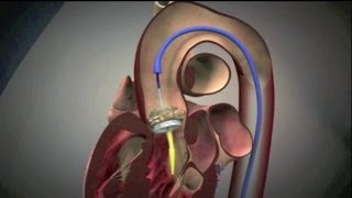 Transcatheter Aortic Valve Implantation TAVI [upl. by Raymund821]