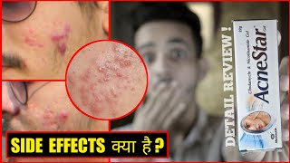 AcneStar Gel Honest Review  Side Effects Its Work Or Not Usage  Hindi [upl. by Yaf]