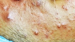 Extraction dacné kystique et pustule  cystic acne [upl. by Netsuj]