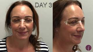 Exercises to speed lower blepharoplasty eyelid surgery recovery [upl. by Schnurr]