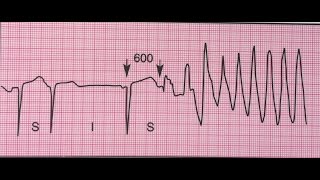 Torsades de pointes tachycardie ventriculaire [upl. by Percy]