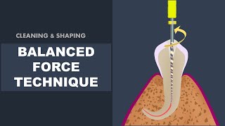 Balanced Force Technique  Cleaning and Shaping [upl. by Georgianne]