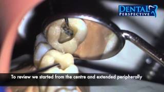 Lower First Molar  Access Cavity  Endo HD  Dental Perspective [upl. by Dwight191]