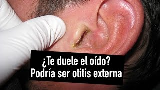 ¿Te duele el oído [upl. by Ailem]