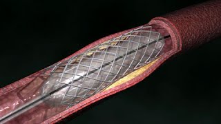 Angioplasty Procedure Animation Video [upl. by Idok]