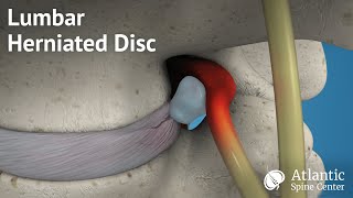 Lumbar Herniated Disc Overview [upl. by Kenimod]