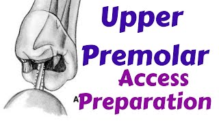 Upper Maxillary Premolars  Endodontic Access cavity Preparation Endodontic Lecture amp Tutorial [upl. by Aicetal]