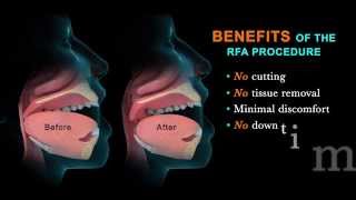 Radiofrequency Ablation Treatment for Barretts Esophagus [upl. by Wolfgang]