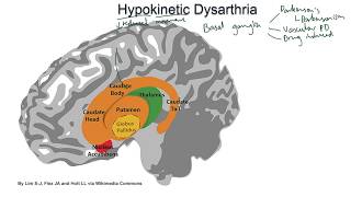 Hypokinetic Dysarthria  examples and tutorial [upl. by Idaline]