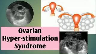 Case report Ovarian Hyperstimulation Syndrome OHSS🤰🤰USG imagingRadiology 20 [upl. by Aloel]