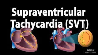 Supraventricular Tachycardia SVT PSVT Animation [upl. by Janicki403]